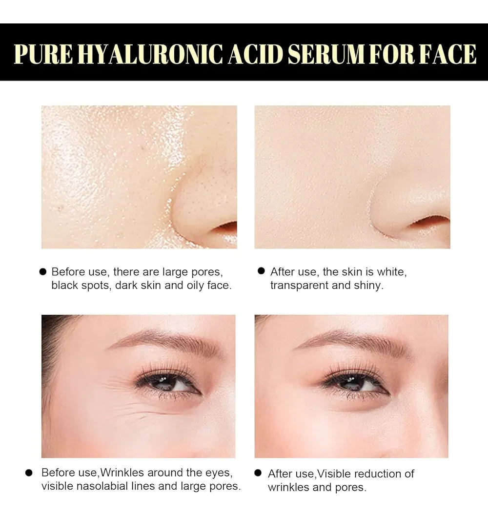 Hilos Tensores Faciales X20 Proteína Colageno Lifting