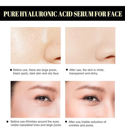 Hilos Tensores Faciales X20 Proteína Colageno Lifting